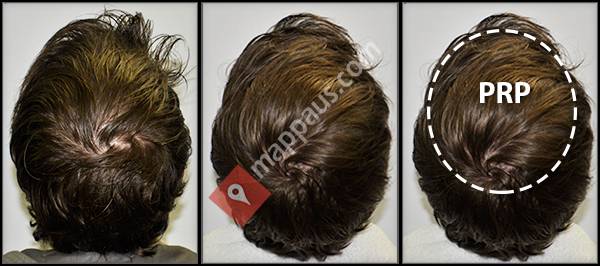 PRP for Hair Loss by Great Directions